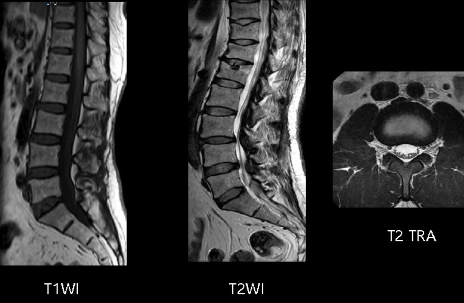 Whole-spine MRI scanning