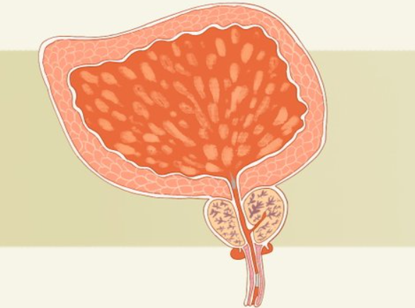Rectal distension directly influences the position and shape of the prostate in ...