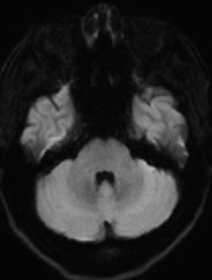 Choosing the Right Diffusion Sequence on Siemens MRI