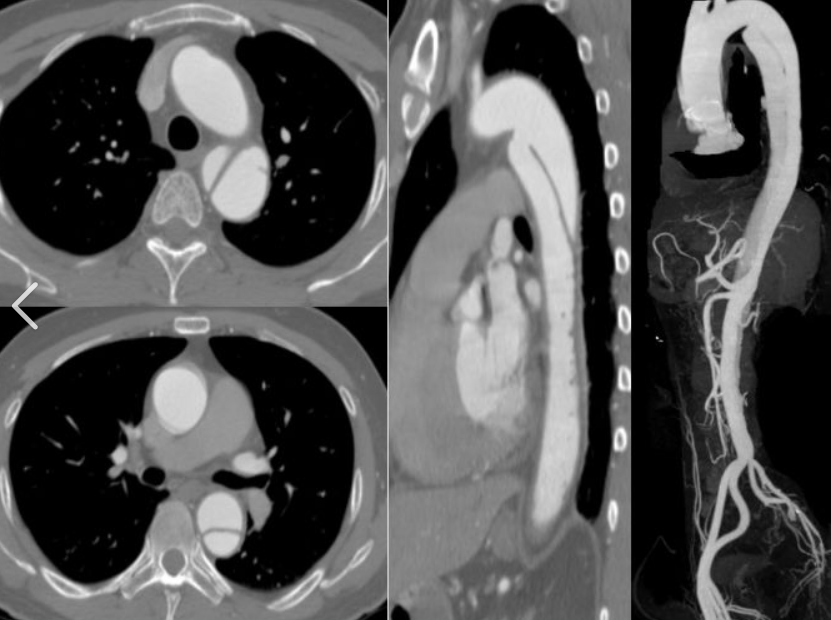Combined CTA Scanning of the Head and Neck Arteries, Thoracic Aorta, and Abdomin...